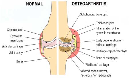 Sendi yang normal dengan sendi yang terkena Osteoarthritis.